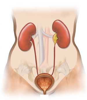 Illustration of ureter stricture obstructing urine flow