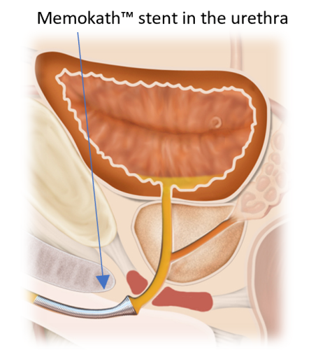 Illustration of urethra with Memokath stent restoring urine flow