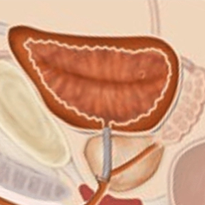 Illustration of prostate with Memocore™ 066 fiducial marker inserted through the urethra for external beam radiation therapy