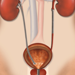 Illustration of urinary tract with Memokath™ 051 metallic stents placed in both ureters.