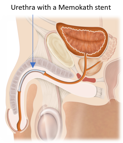 Illustration of penile urethral stricture with Memokath stent restoring urine flow