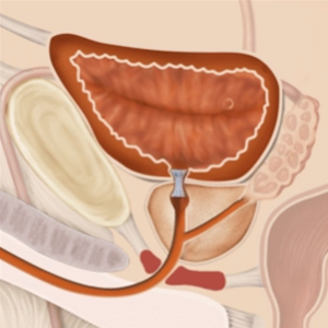 Illustration of bladder neck with Memokath™ 045 metallic stent inserted to treat bladder neck stricture.