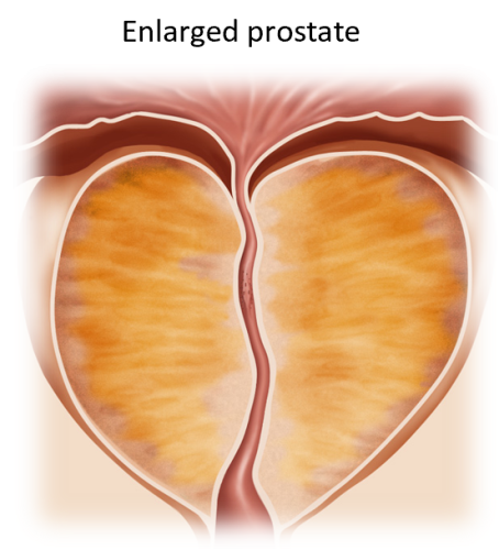 Illustration of enlarged prostate