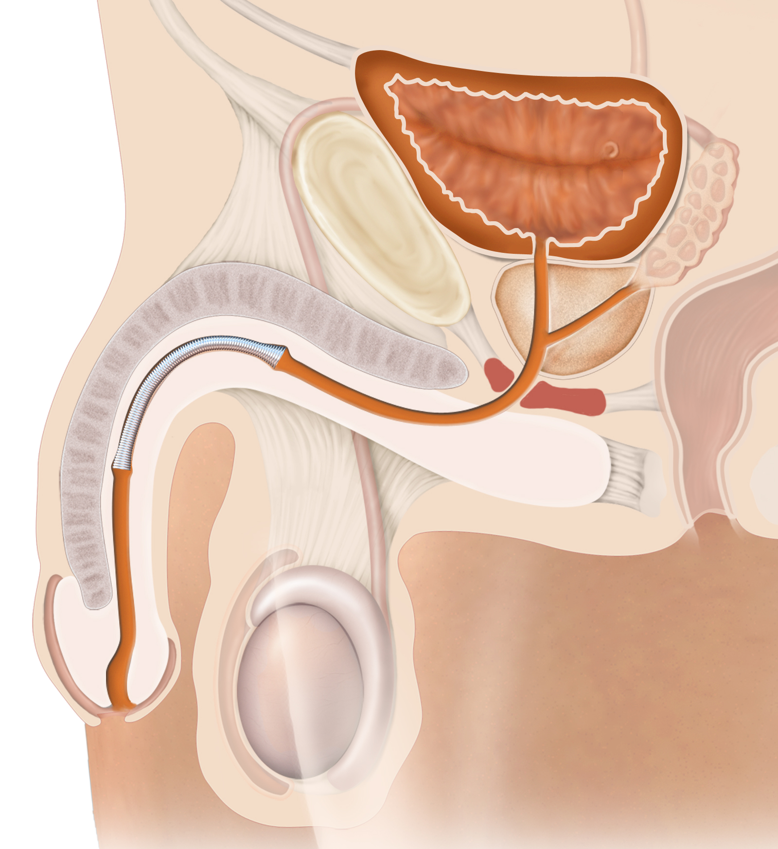 Illustration of Memokath™ 045 Bladder Neck stent supporting the bladder outlet.