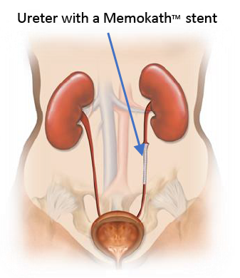Illustrtation of ureter with Memokath stent restoring urine flow