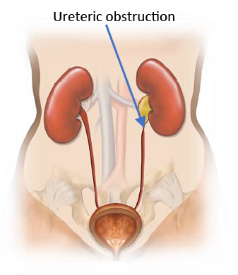 Illustration of ureter stricture obstructing urine flow