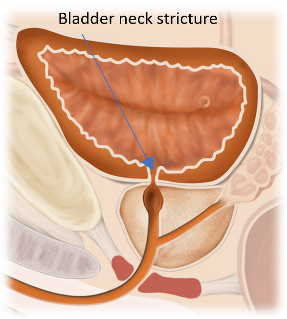 Illustration of bladder neck stricture obstructing urine flow