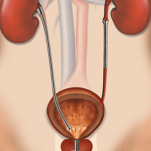 Illustration of three Memokath™ 051 Ureter stents placed in the ureters.