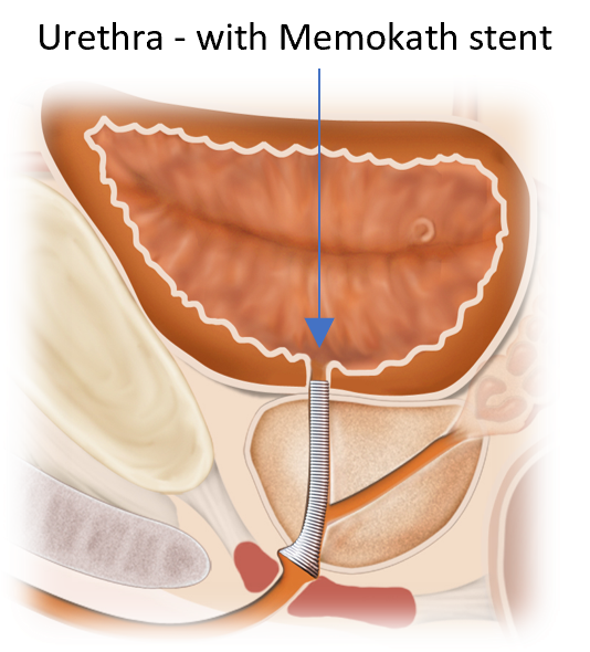 Illustration of prostatic obstruction with Memokath stent restoring urine flow