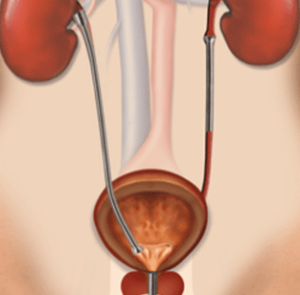 Illustration of ureter with three Memokath stents restoring flow