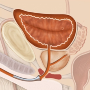 Illustration of urethra with Memokath™ 044 metallic stent inserted to treat bulbar urethral stricture.