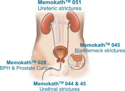 Medical illustration of the urinary tract highlighting treatment areas for Memokath stents 028, 044, 045, and 051