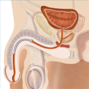 Illustration of penile urethra with Memokath™ 045 metallic stent inserted to relieve urethral stricture.