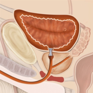 Illustration of the bladder neck with a Memokath 045 stent inserted