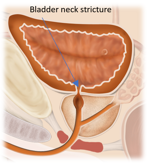 Illustration of bladder neck stricture obstructing urine flow