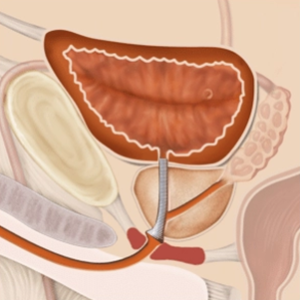 Illustration of prostate with Memokath™ 028 metallic stent inserted to treat prostatic obstruction.