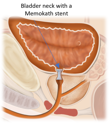 Illustration of bladder neck with Memokath stent restoring urine flow