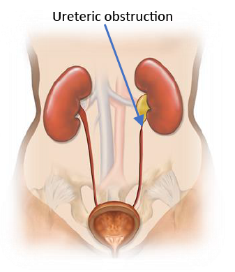 Illustration of ureter stricture obstructing urine flow