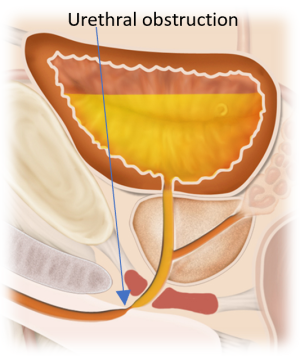 Illustration of urethral stricture obstructing urine flow