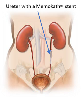 Illustrtation of ureter with Memokath stent restoring urine flow