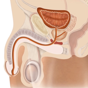 Illustration of penile urethral stricture 